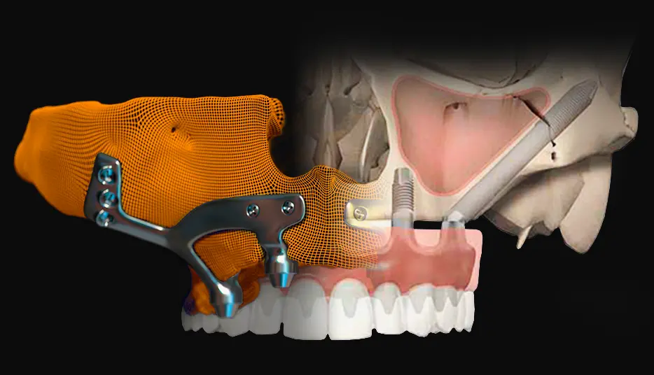 Implante dentário estrutural sob medida realizado pelo Dr. Fábio Trevisan em SP